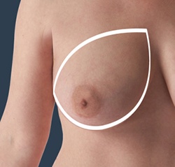 Breast Shape Changes