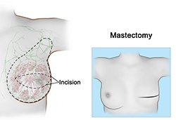 Mastectomy