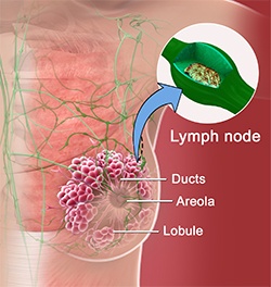 Sentinel Node Biopsy